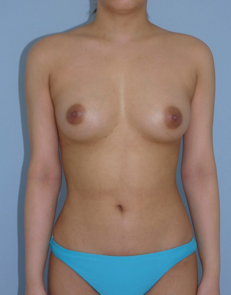 胸 - 脂肪注入 症例写真（手術7ヵ月）（正面）