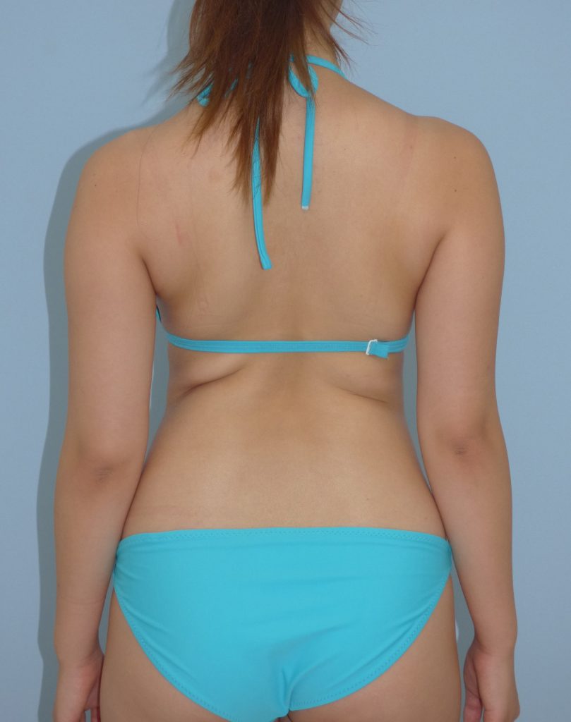 二の腕 - 脂肪吸引 症例写真（手術前）（後面）
