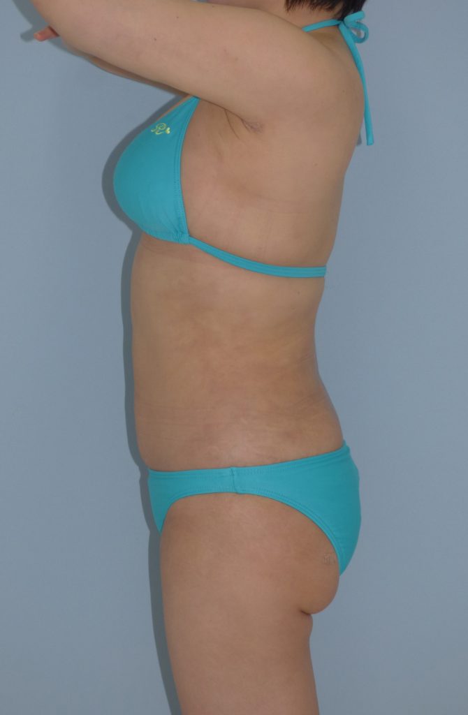 お腹 - 脂肪吸引 症例写真（手術後1ヵ月）（横）