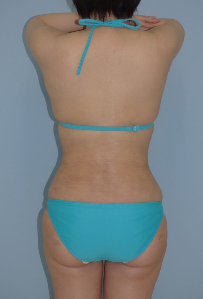 お腹 - 脂肪吸引 症例写真（手術後1ヵ月）（後面）