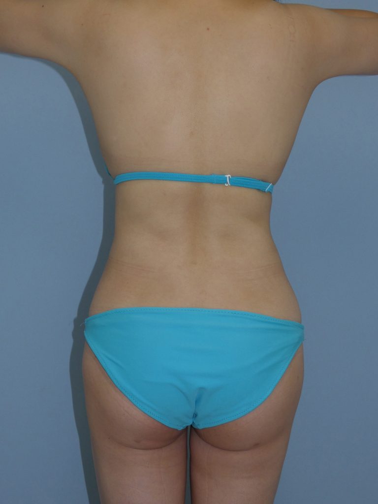 お腹 - 脂肪吸引 症例写真（手術後6ヵ月）（後面）