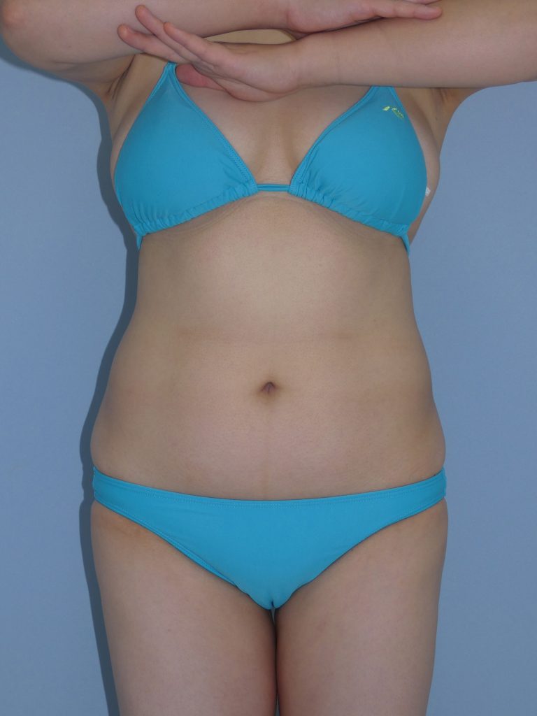 お腹の脂肪吸引　27歳 女性 159cm 62kg