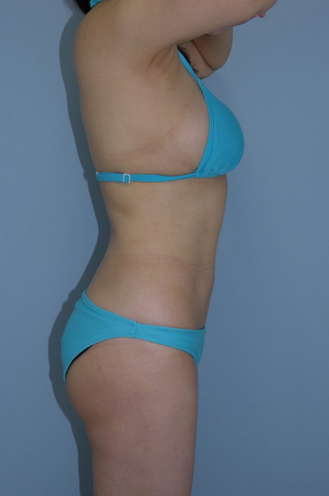 お腹 - 脂肪吸引 症例写真（手術後6ヵ月）（横）