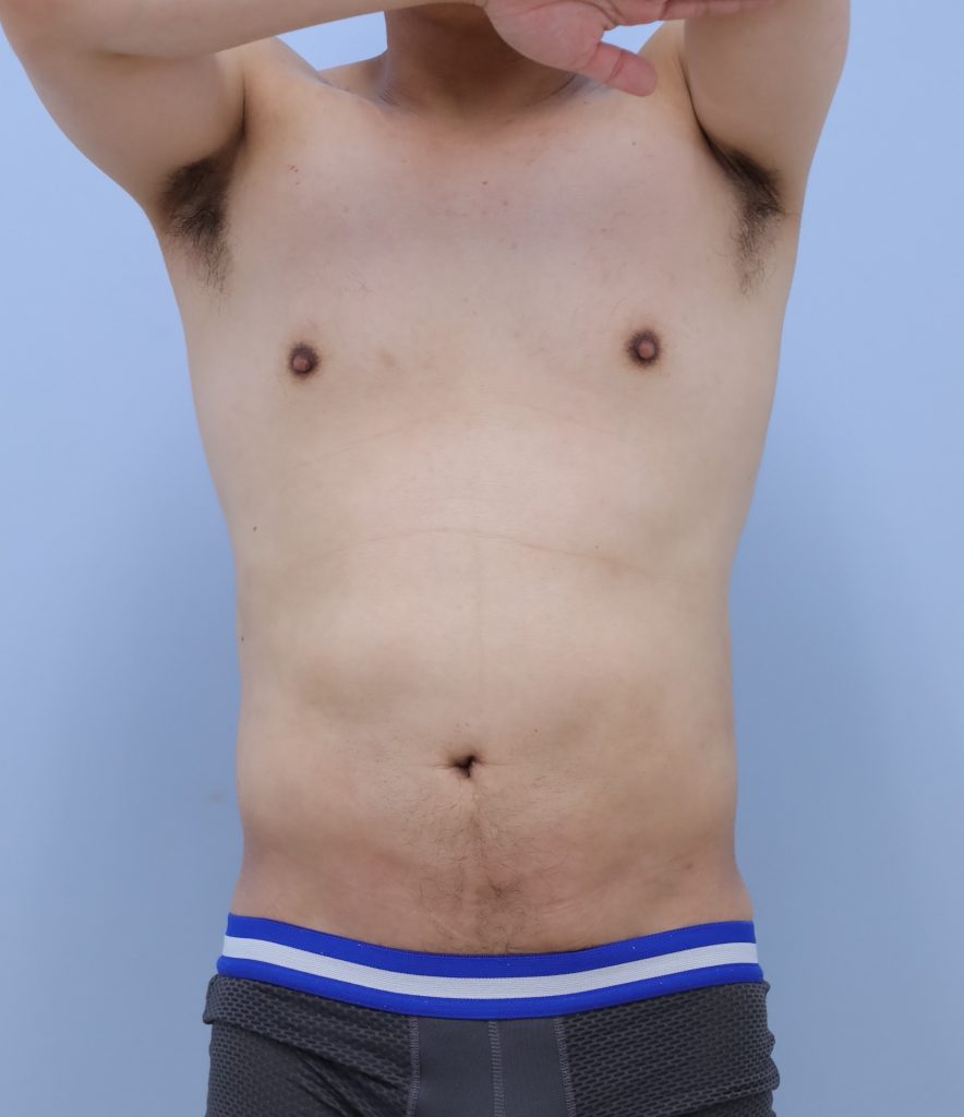 お腹 - 脂肪吸引 症例写真（手術後1ヶ月）（正面）