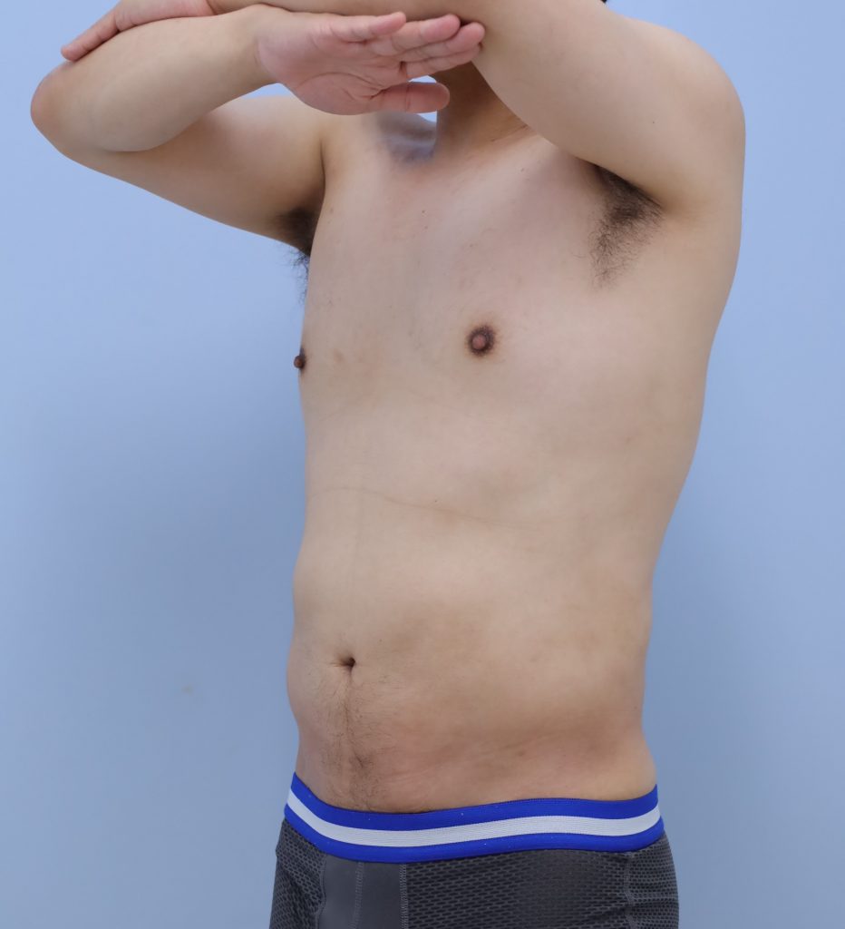 お腹 - 脂肪吸引 症例写真（手術後1ヶ月）（斜め）