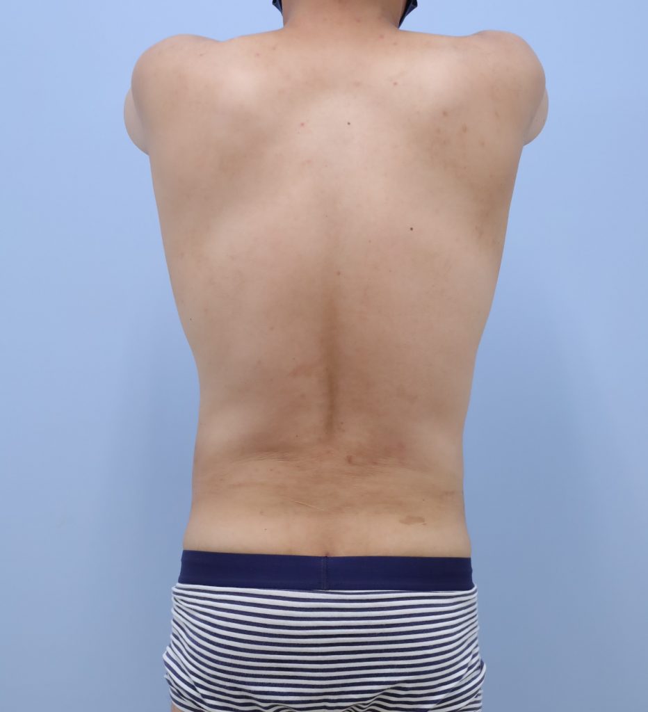 お腹 - 脂肪吸引 症例写真（手術後3ヶ月）（後面）