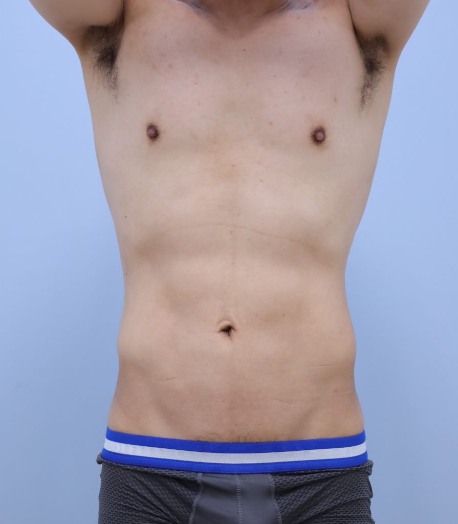 お腹 - 脂肪吸引 症例写真（手術後7ヶ月）（正面）