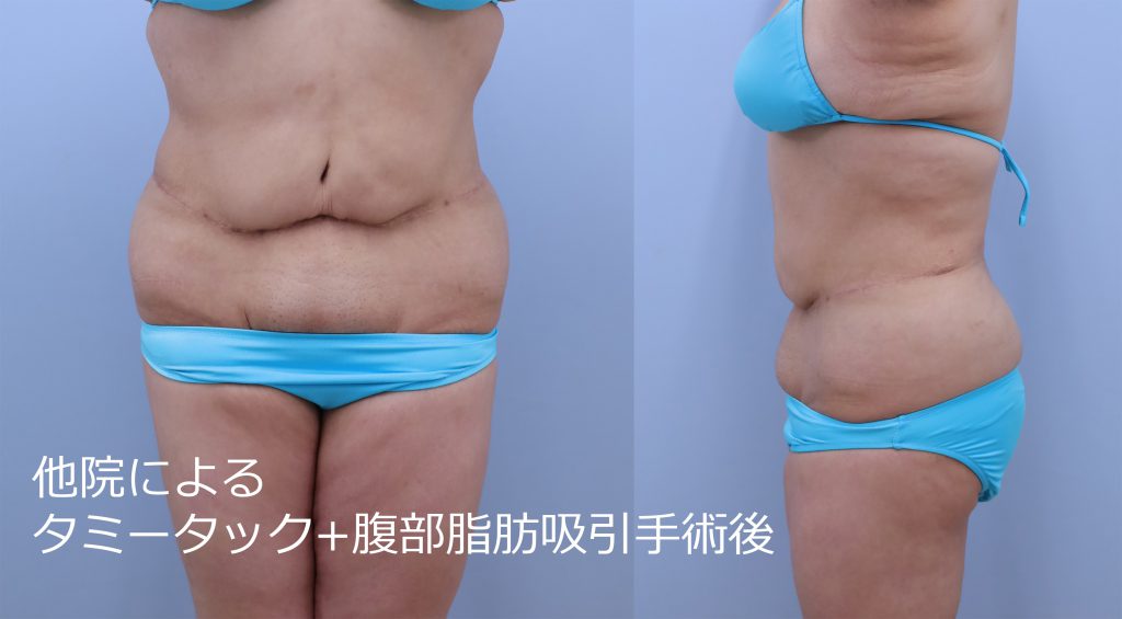 他院タミータック術後 取り残された皮下脂肪の修正手術