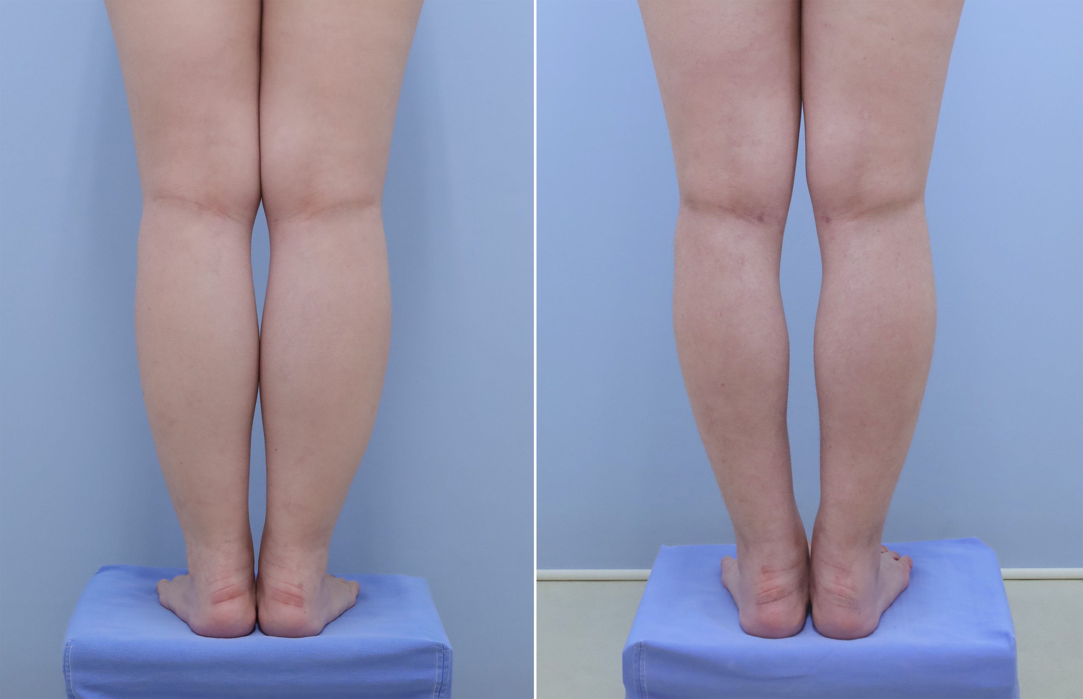 下腿の脂肪吸引　3ヶ月　25歳 154cm 44kg