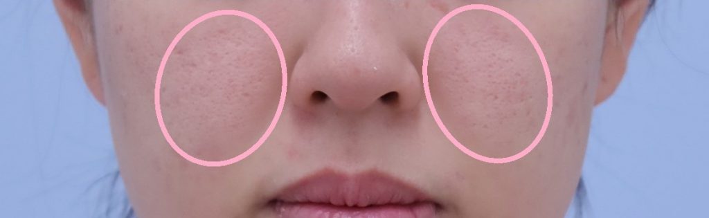 メーラーファットの脂肪吸引　26歳 150cm 47kg