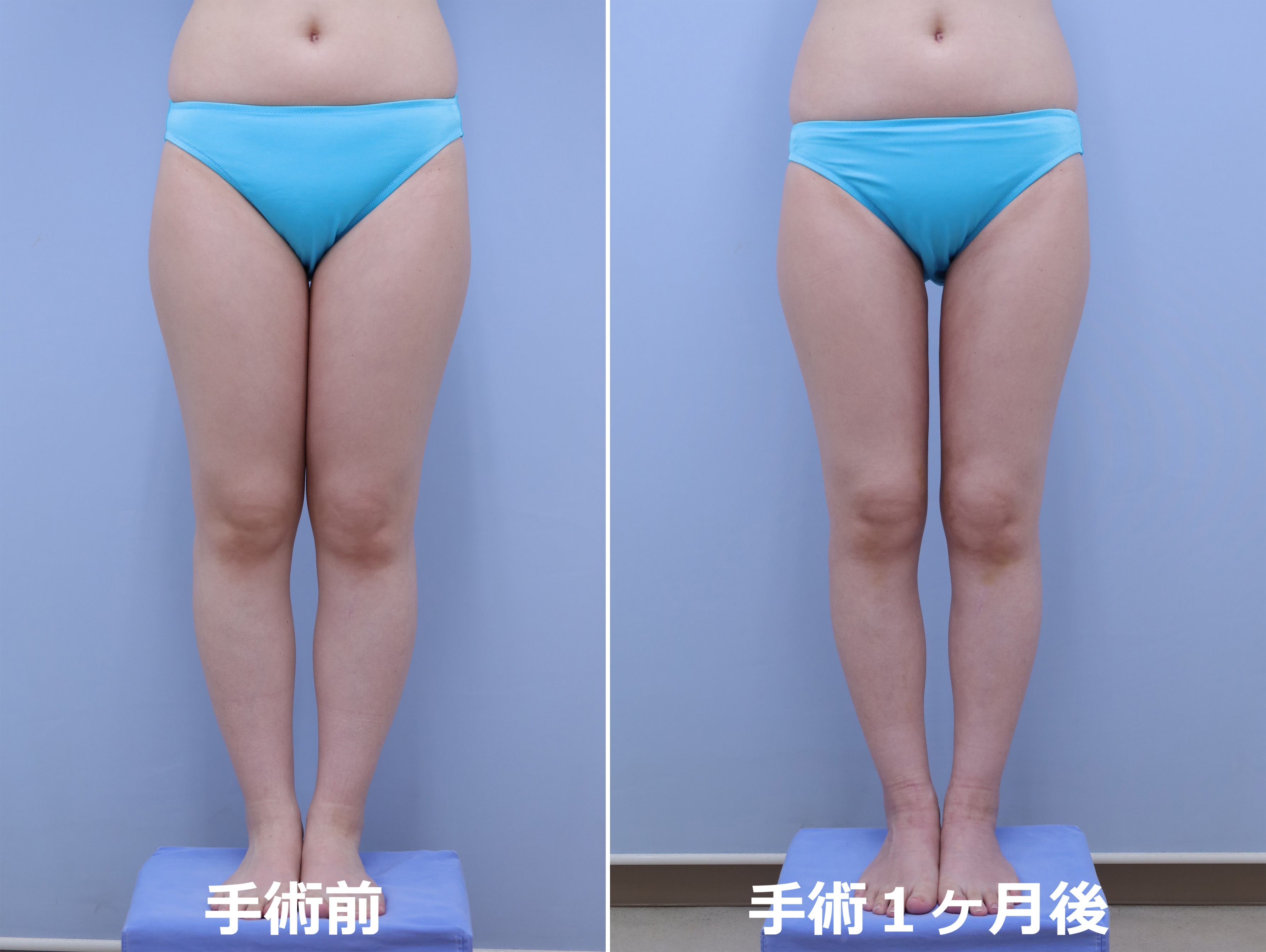太もも内側・膝・下腿足首の脂肪吸引　37歳 151cm 45kg