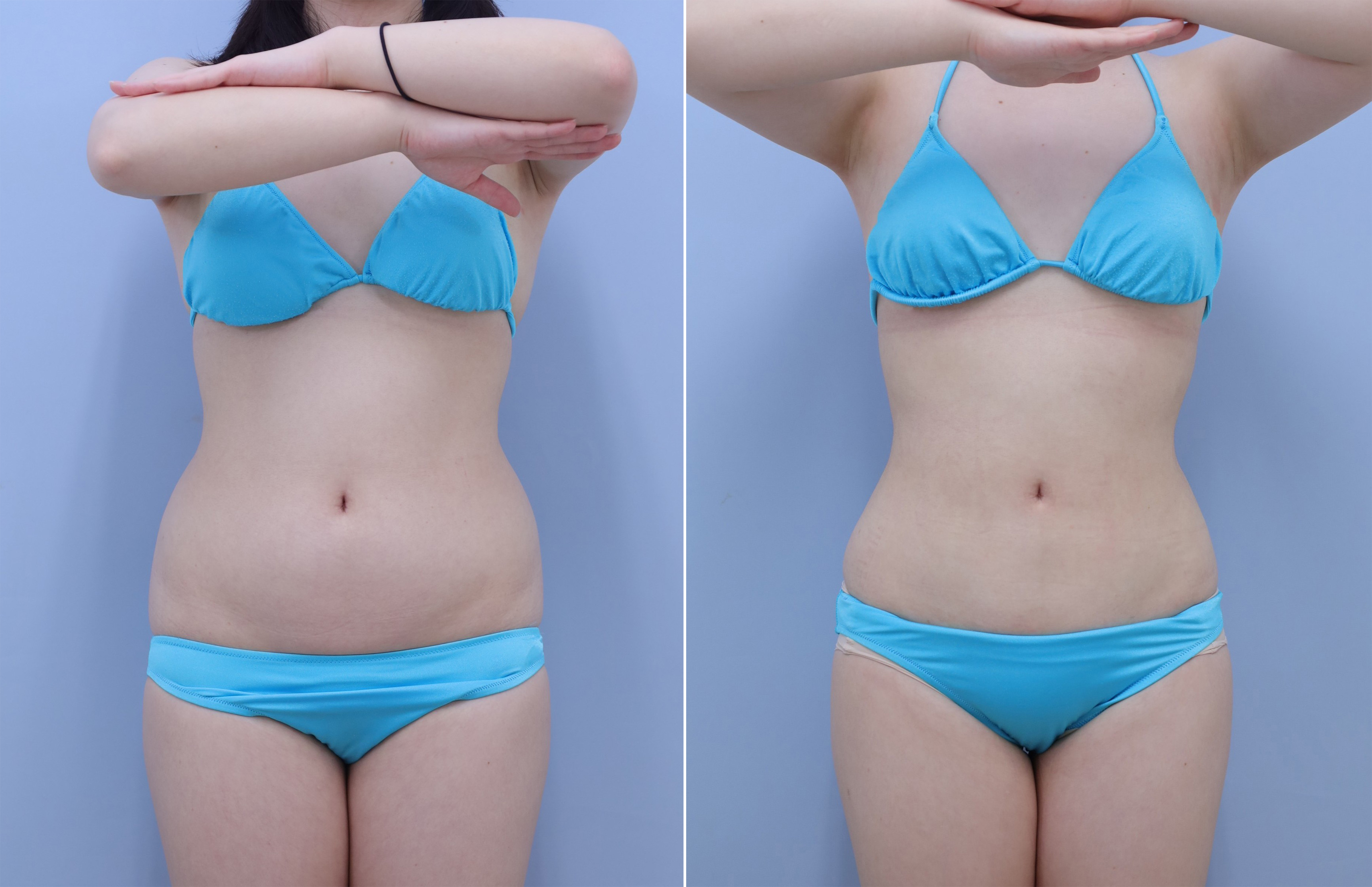 お腹の脂肪吸引23歳 女性 155cm 54kg