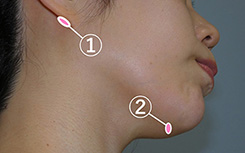 顔の脂肪吸引の傷の位置