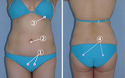 お腹の脂肪吸引の傷の位置