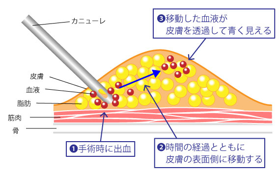 内出血について