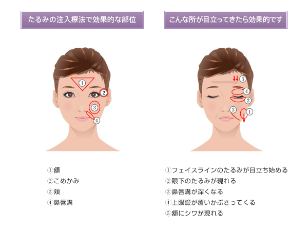 ヒアルロン酸注入法