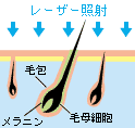 医療レーザー脱毛