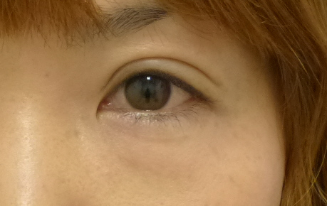 眼瞼下垂の症例写真（手術後3ヶ月）