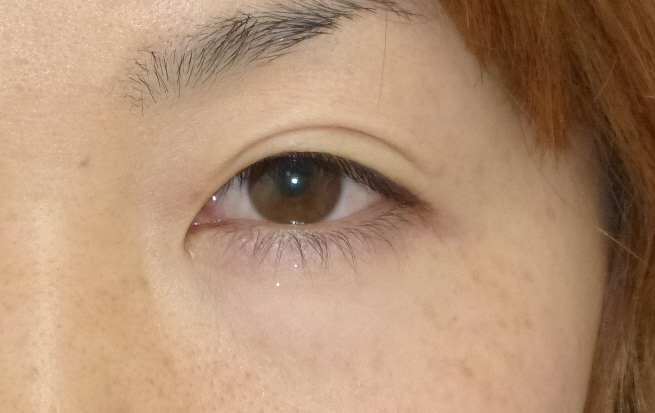 眼瞼下垂の症例写真（手術前）