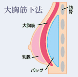 大胸筋下法