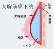 大胸筋下法