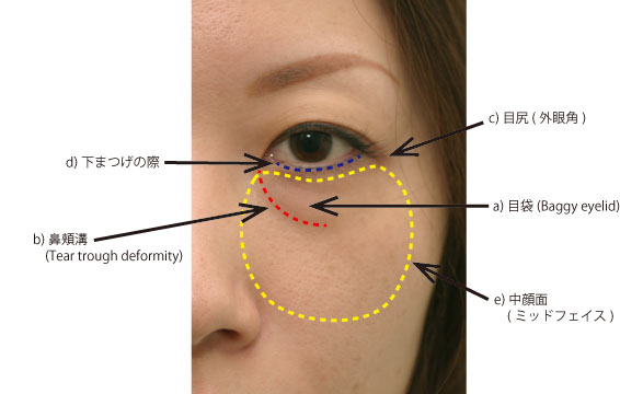 経結膜的眼窩脂肪移行術