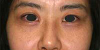 目のくま-経結膜的眼窩脂肪移動術（トラコンハムラ）の症例写真（治療開始3クール後）