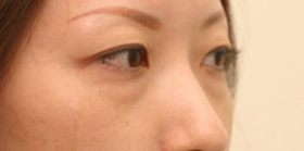 目のくま-経結膜的眼窩脂肪移動術（トラコンハムラ）の症例写真（治療前）