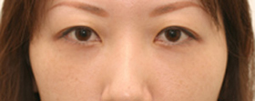 目のくま-経結膜的眼窩脂肪移動術（トラコンハムラ）の症例写真（治療後）