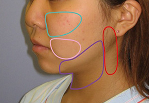 顔の脂肪吸引：脂肪のつき方
