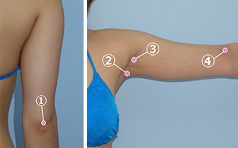 二の腕の脂肪吸引：傷の位置