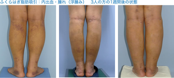 ふくらはぎ 脂肪吸引 脂肪吸引ならクリニック日比谷