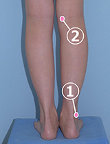 ふくらはぎの脂肪吸引：傷の位置