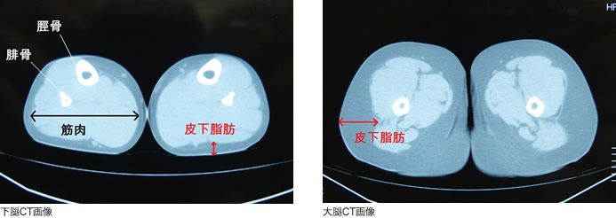 ふくらはぎの脂肪吸引：脂肪のつき方