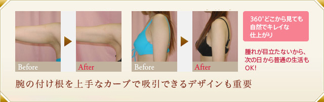 腕の付け根のビフォーアフター