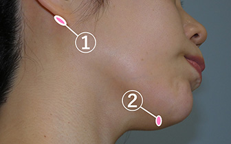 顔の脂肪吸引：傷の位置