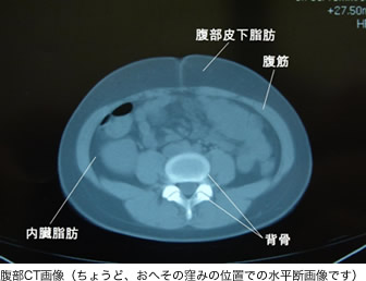 腹部の脂肪吸引：脂肪のつき方