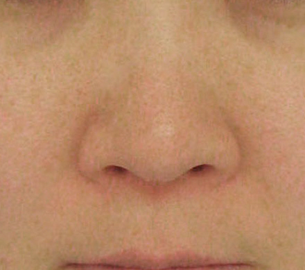 鼻先縮小施術の症例写真（手術前）
