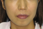 鼻唇溝のプチ整形－ヒアルロン酸注射の症例写真（注入直後）