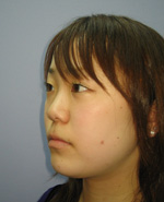 鼻のプチ整形－ヒアルロン酸注射の症例写真（注入前）