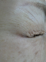 目尻のプチ整形－ボトックス注射の症例写真（注入後7日）