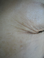 目尻のプチ整形－ボトックス注射の症例写真（注入前）