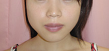 エラ（噛筋）のプチ整形－ボトックス注射の症例写真（注入前）