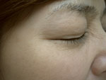 目尻のプチ整形－ボトックス注射の症例写真（注入後10日後）