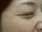 目尻のプチ整形－ボトックス注射の症例写真（注入前）