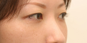 目のくま-経結膜的眼窩脂肪移動術(トラコンハムラ)の症例写真(治療後)