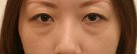 目のくま-経結膜的眼窩脂肪移動術(トラコンハムラ)の症例写真(治療前)