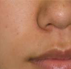 症例写真:炭酸ガスレーザーによるホクロの治療(手術後6ヶ月)