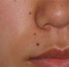 症例写真:炭酸ガスレーザーによるホクロの治療(治療前)