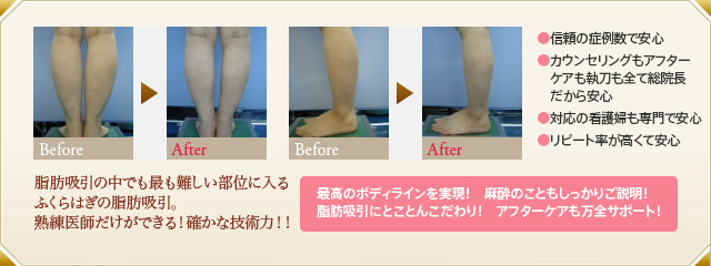 ふくらはぎと足首のビフォーアフター